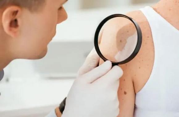 mụn thịt, chăm sóc sức khỏe, da có mụn thịt