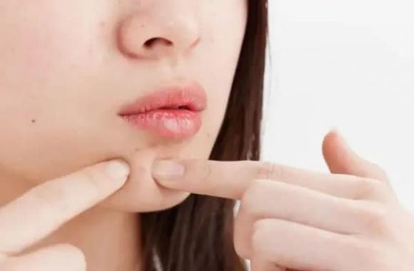 mụn thịt, chăm sóc sức khỏe, da có mụn thịt