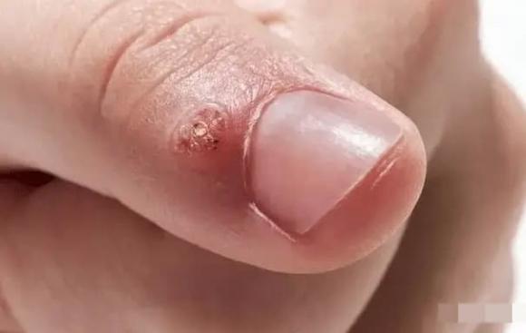 nhiễm HPV