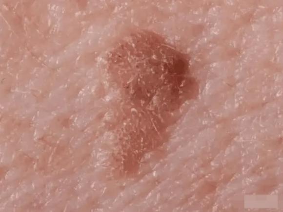 nhiễm HPV