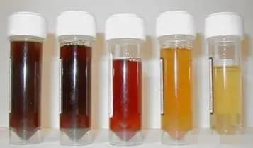 bệnh thận, đi tiểu, bệnh thận