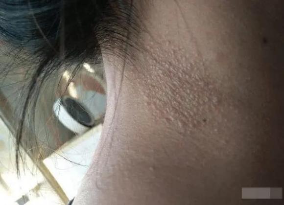 HPV, bệnh HPV