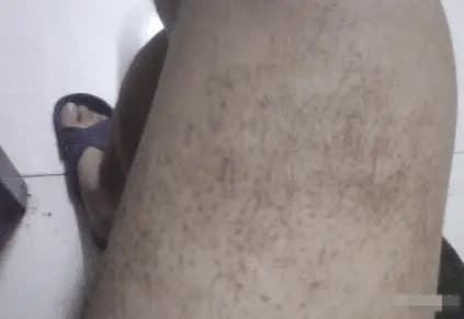 HPV, bệnh HPV