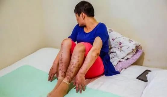 AIDS, người bị AIDS