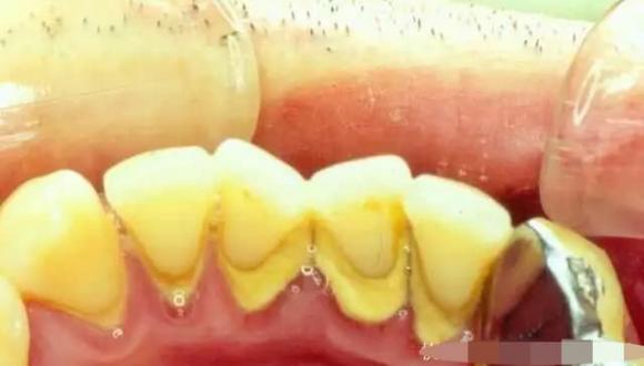 cao răng, vôi răng, loại bỏ cặn răng