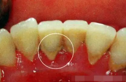cao răng, vôi răng, loại bỏ cặn răng