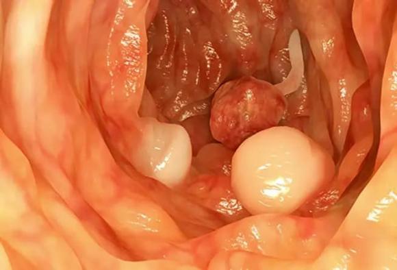  polyp ruột,  ung thư đại tràng