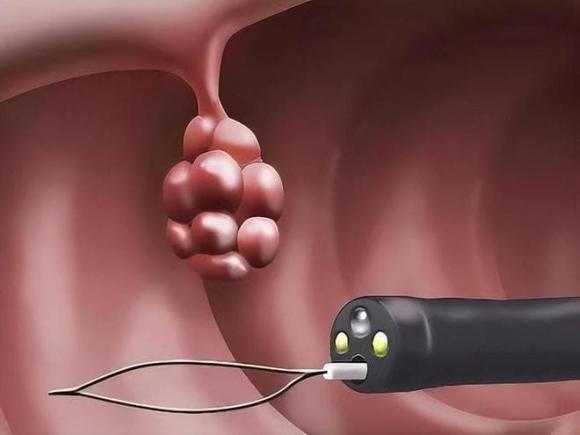 Polyp ruột, Polyp 