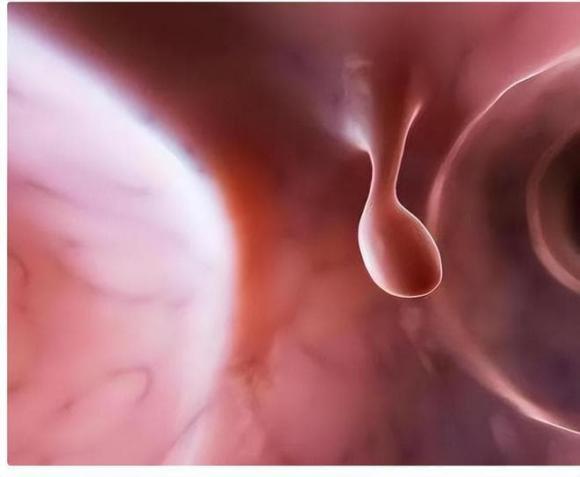 Polyp ruột, Polyp 