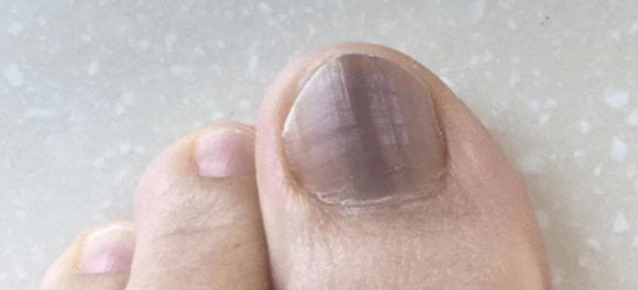 móng tay đen, khối u ác tính