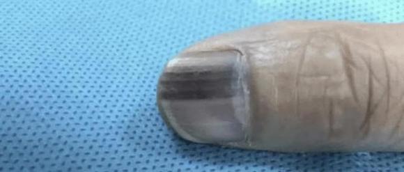 móng tay đen, khối u ác tính