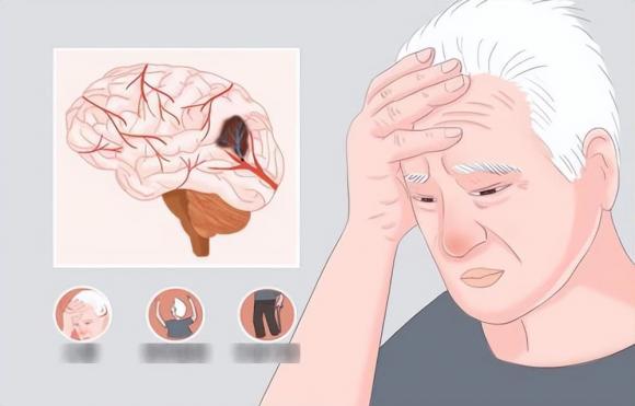 thiếu máu lên não, cách cung cấp đủ máu lên não, thiếu máu não phải làm gì
