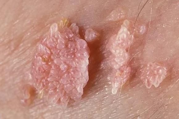  ung thư cổ tử cung, nhiễm hpv