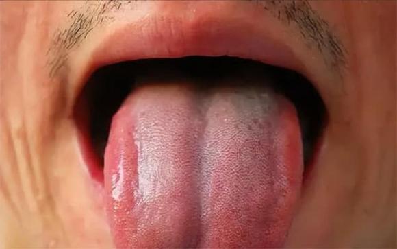 lưỡi, chăm sóc sức khỏe, bệnh tật