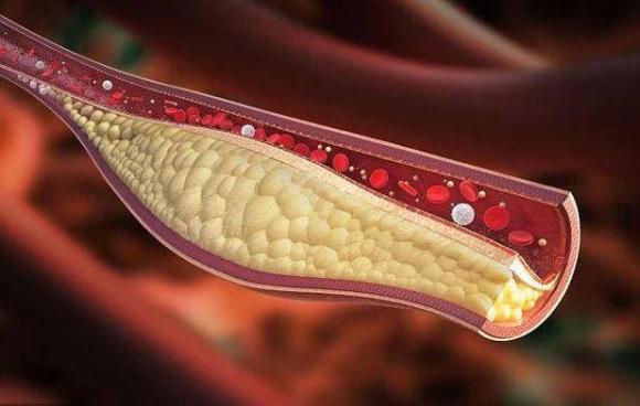 cholesterol cao, thực phẩm cholesterol cao