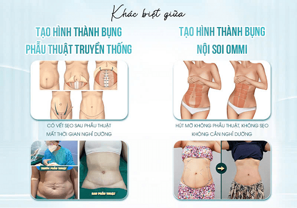 giảm mỡ bụng, giảm eo, nội soi Ommi, JK Nhật Hàn, Bệnh viện Thẩm mỹ JK Nhật Hàn