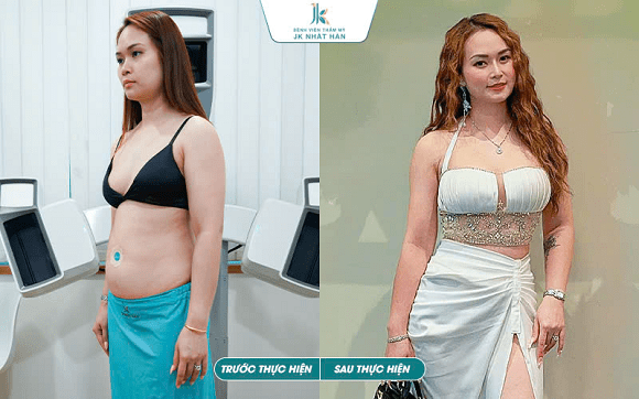 giảm mỡ bụng, giảm eo, nội soi Ommi, JK Nhật Hàn, Bệnh viện Thẩm mỹ JK Nhật Hàn