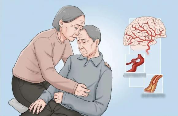 đột quỵ, đột quỵ ở người già