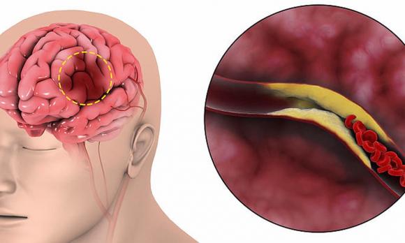 nhồi máu não, sức khỏe, chăm sóc sức khỏe, nguyên nhân gây nhồi máu não, thủ phạm gây nhồi máu não