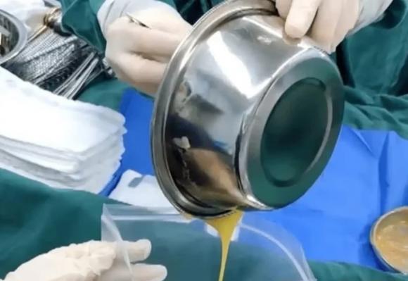 nâng ngực, nâng ngực hỏng, làm đẹp