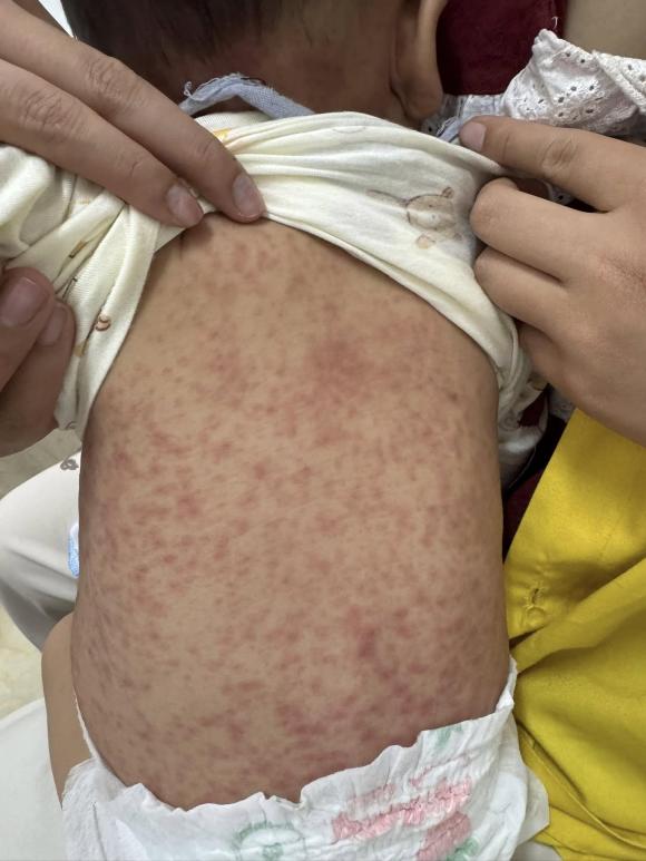 bệnh sởi, mắc lại bệnh sởi, sức khỏe
