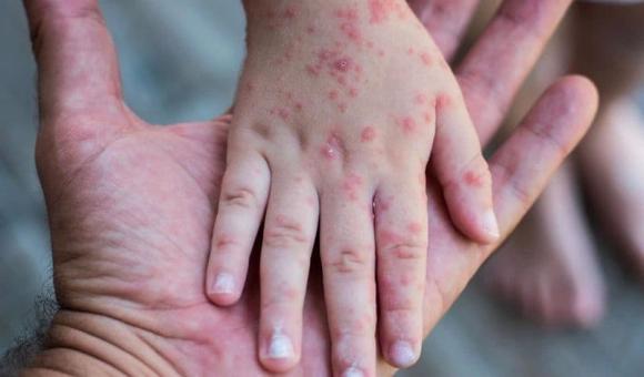bệnh sởi, mắc lại bệnh sởi, sức khỏe