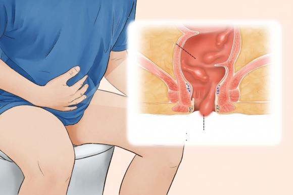 polyp ruột, dấu hiệu polyp trong ruột