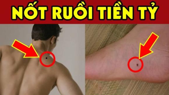 nốt ruồi, vị trí nốt ruồi, kiến thức
