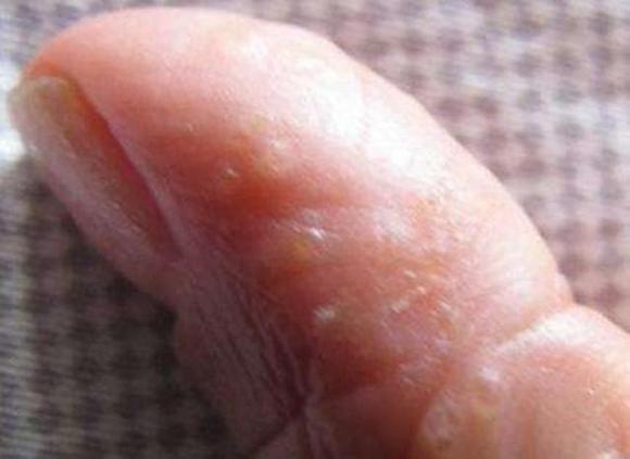 mụn nước
