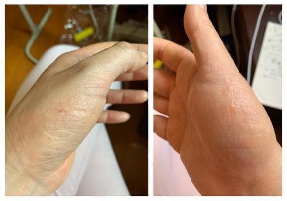 mụn nước