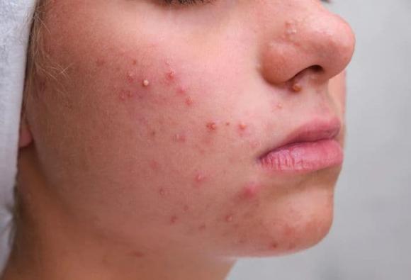 Tiêm meso trị mụn, meso trị mụn