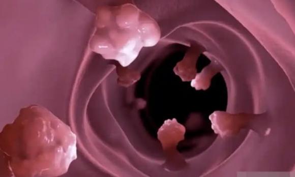 polyp ruột
