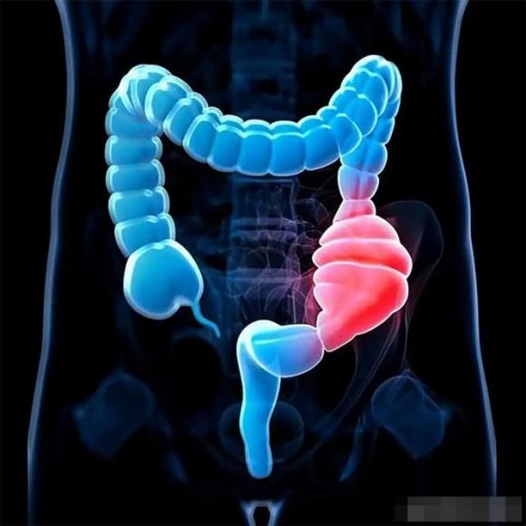 polyp ruột