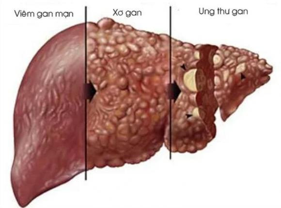viêm dẫn tới ung thư, ung thư