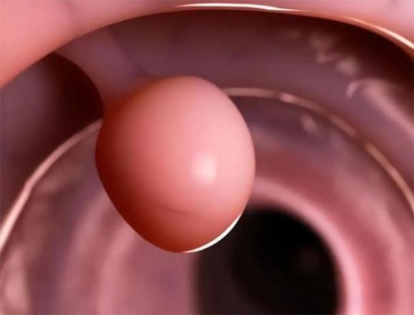 Polyp ruột