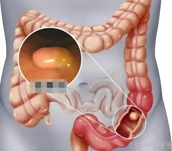 Polyp ruột