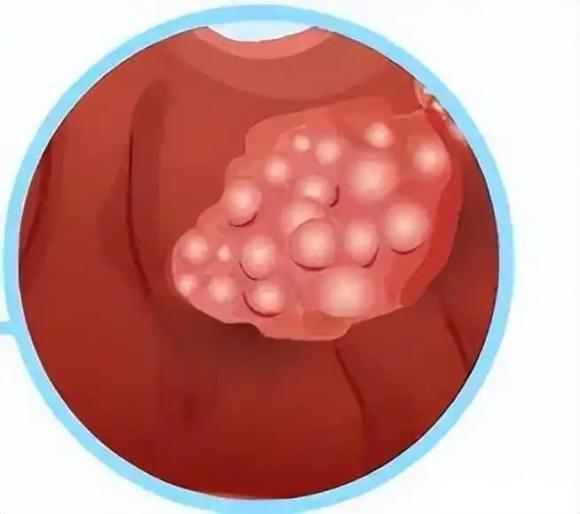 Polyp ruột