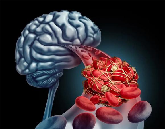 nhồi máu não, đột quỵ