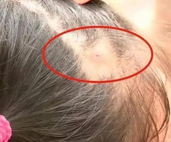 chăm con, trẻ bị bọ tấn công, sức khỏe