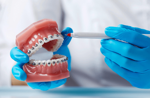 niềng răng, răng thưa, Nha khoa Đăng Lưu