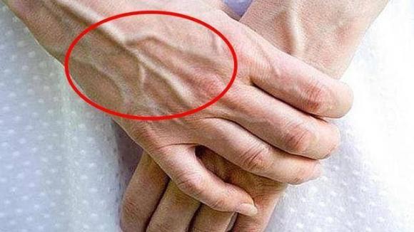 gân xanh, gân xanh là dấu hiệu bệnh gì