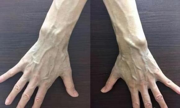 gân xanh, gân xanh là dấu hiệu bệnh gì