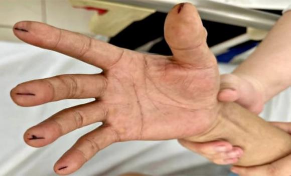 đột quỵ, chích kim vào đầu ngón tay, Cách cứu người bị đột quỵ