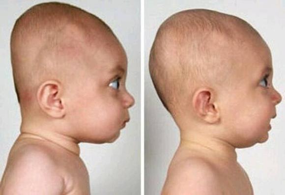 đầu to, đầu bẹt, hình dáng đầu, trẻ thông minh, hình dáng đầu, kích thước đầu