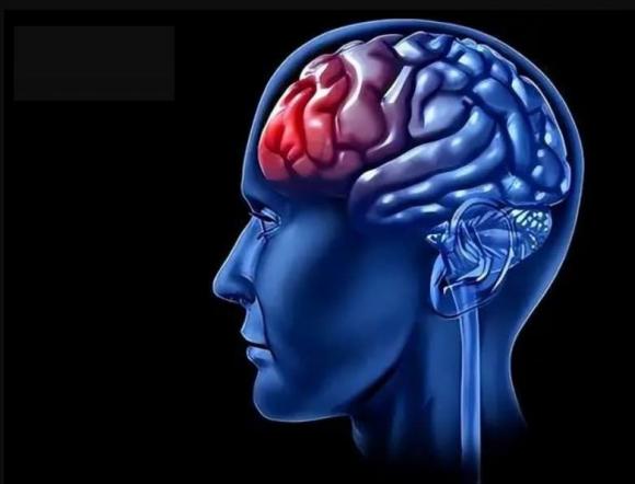 đột quỵ, dấu hiệu đột quỵ, cách sơ cứu người đột quỵ
