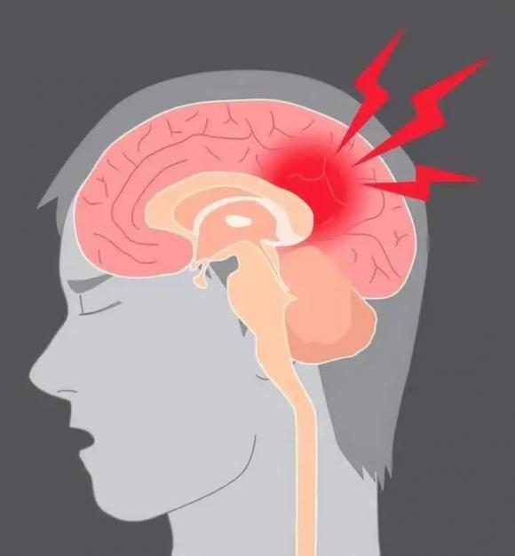 đột quỵ, dấu hiệu đột quỵ, cách sơ cứu người đột quỵ