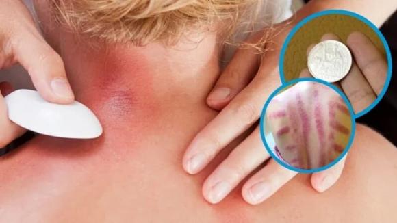 đánh gió, dùng trứng đánh gió, dùng bạc đánh gió