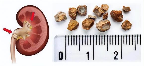 sức khỏe, đau đớn do bệnh, bệnh gây đau đớn, căn bệnh được xem là đau đớn nhất thế giới, bệnh đau nhất thế giới
