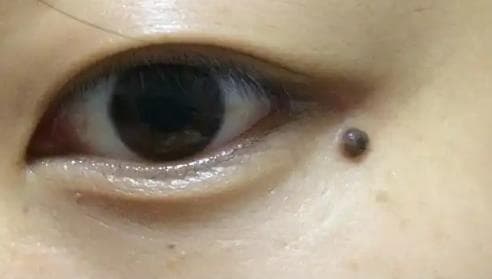nốt ruồi, vị trí nốt ruồi may mắn