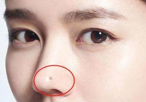 nốt ruồi, vị trí nốt ruồi may mắn